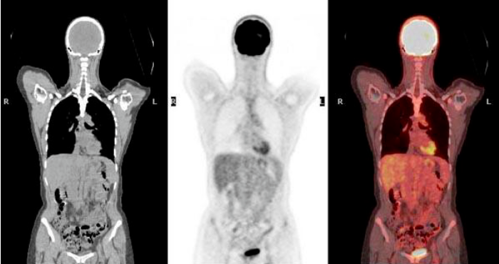 PET Scan Images